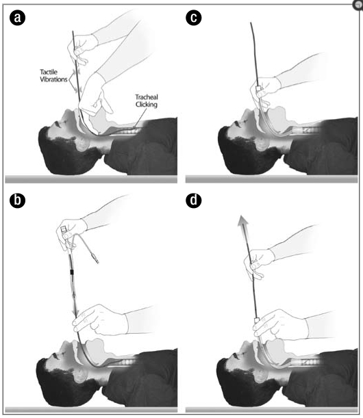 James M Rich Blind Digital Intubation Bougie (Proc Bayl 2008)