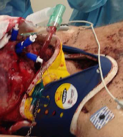 Facial exsanguination splinted